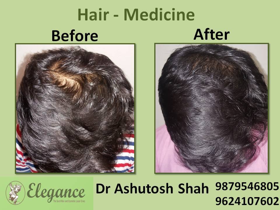 Hair Loss Medicine Treatment, Mangrol, Gujarat, India.