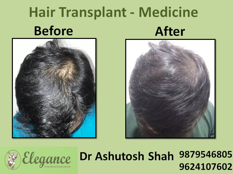 Hair Loss Medicine Treatment, Selvasa, Gujarat, India.