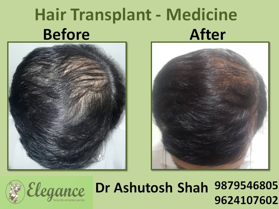Hair Loss Medicine Treatment, Surat, Gujarat, India.