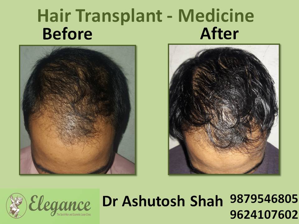 Hair Loss Medicine Treatment, Vapi, Gujarat, India.