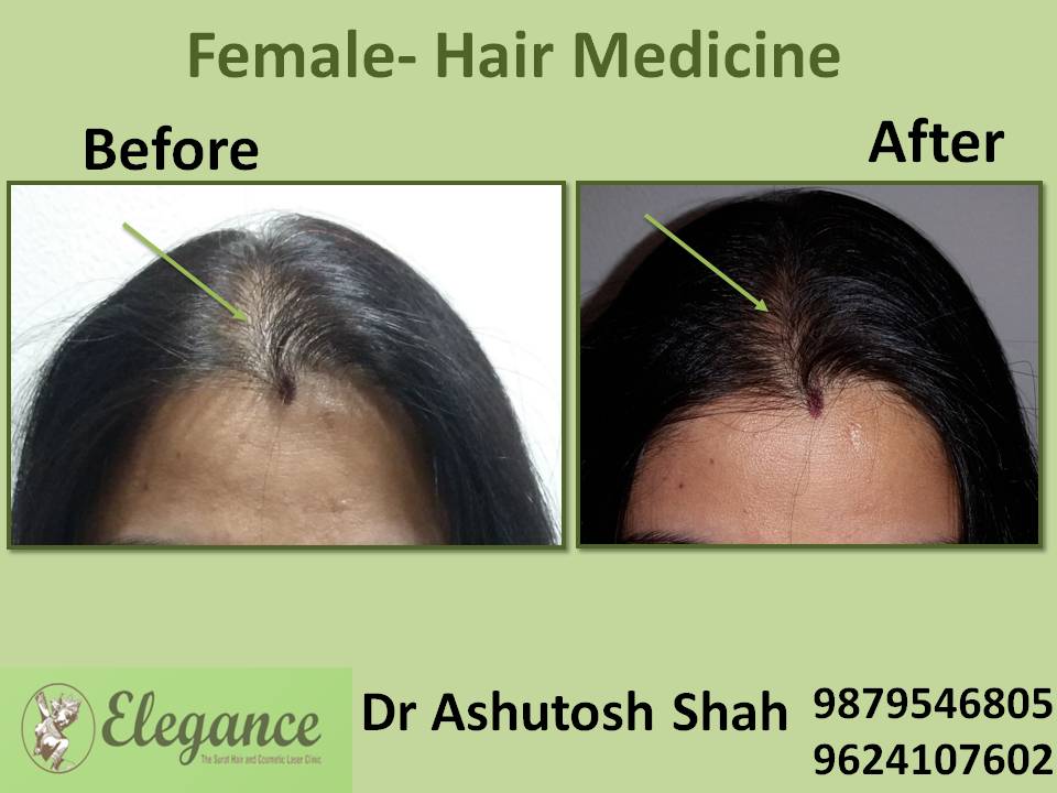 Hair Loss Medicine, Valsad, Gujarat, India.