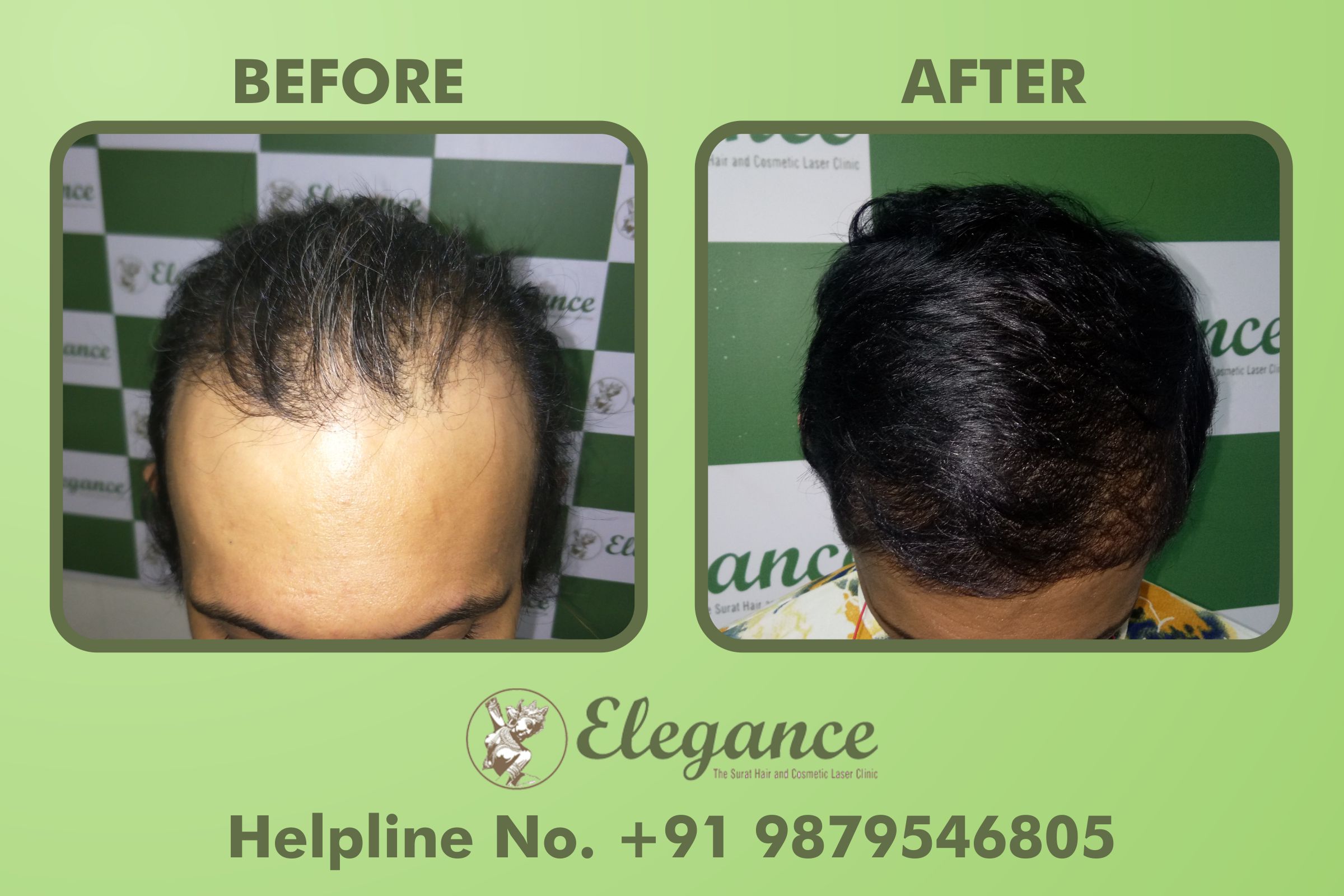 Hair Replacement in Bharuch, Gujarat, India