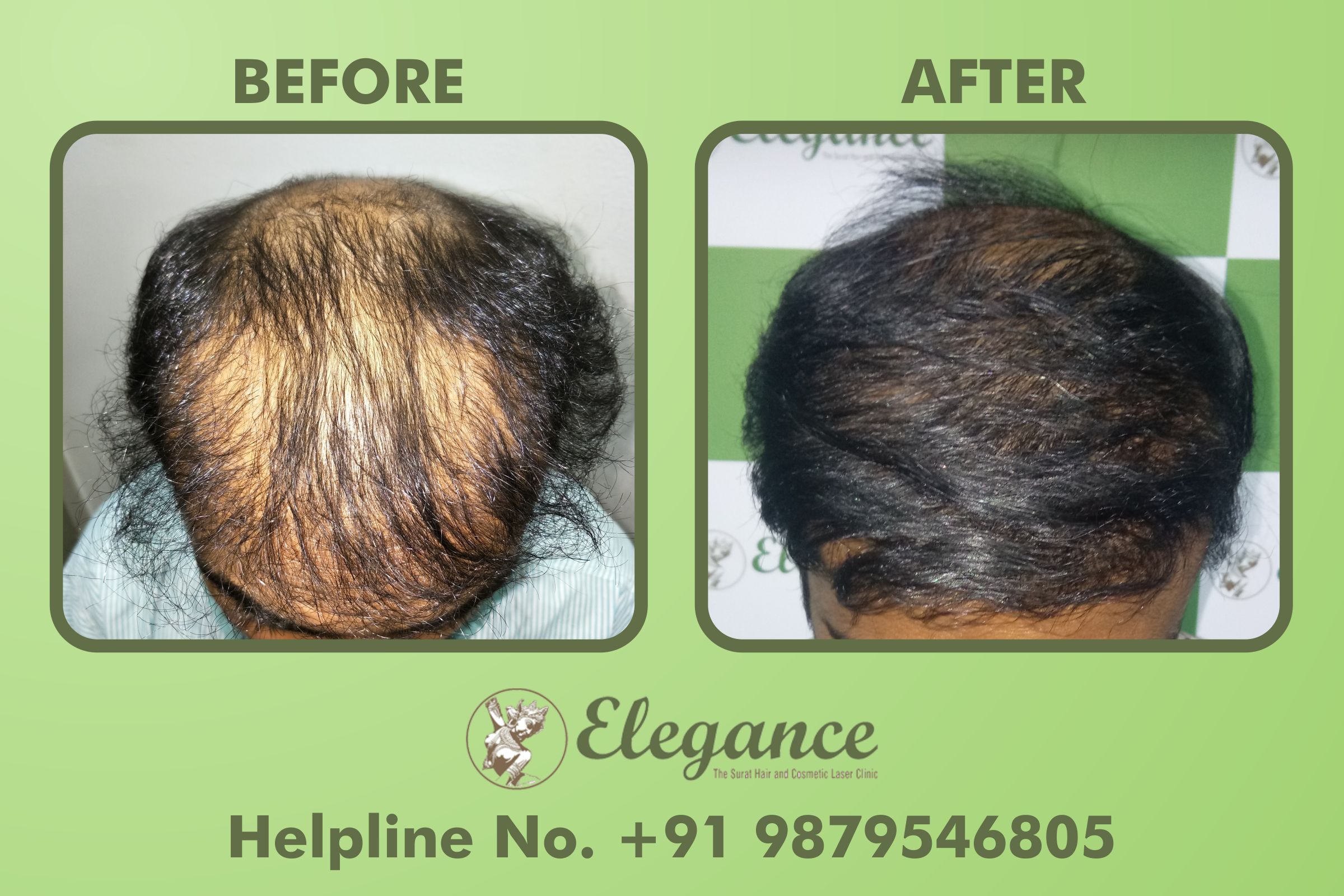 Bharuch, Gujarat, India Hair Transplant Clinic