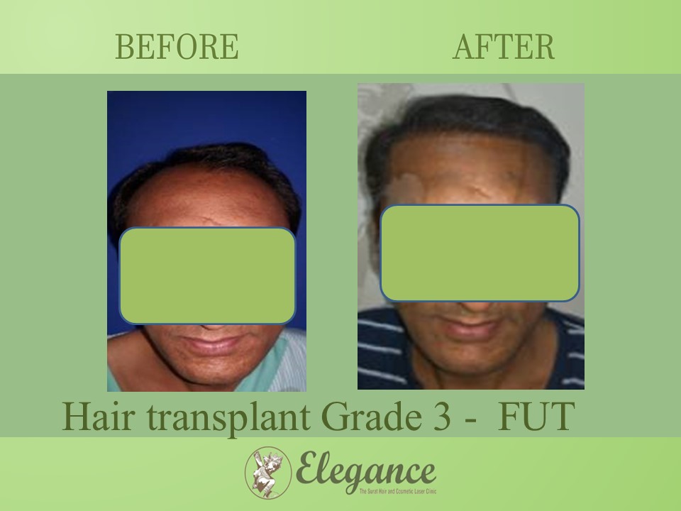 Hair transplant Grade 3 In Bardoli, Gujarat, India