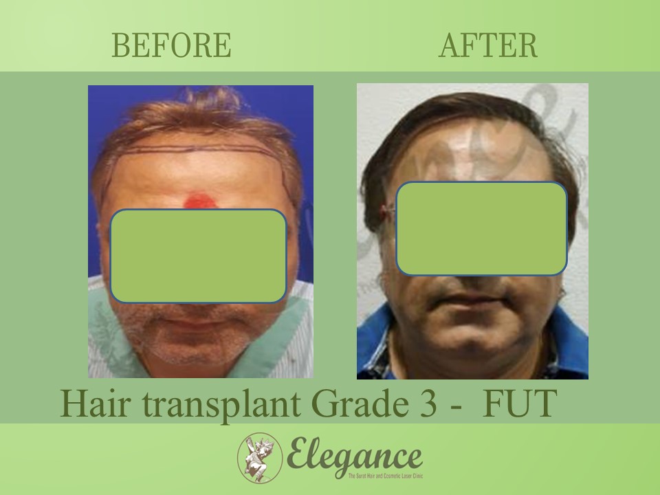 Hair transplant Grade 3 In Bilimora, Gujarat, India