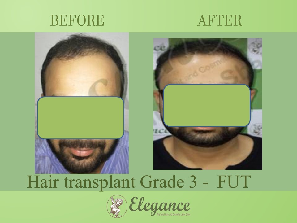 Hair transplant Grade 3 In Chhota Udaipur, Gujarat, India