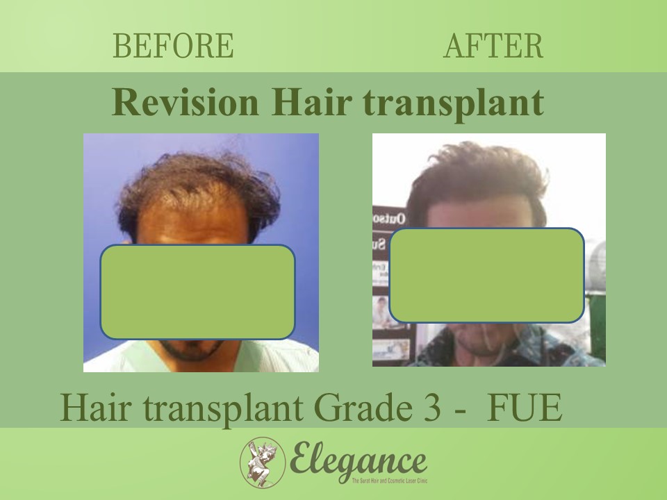 Hair transplant Grade 3 In Chikhli, Gujarat, India