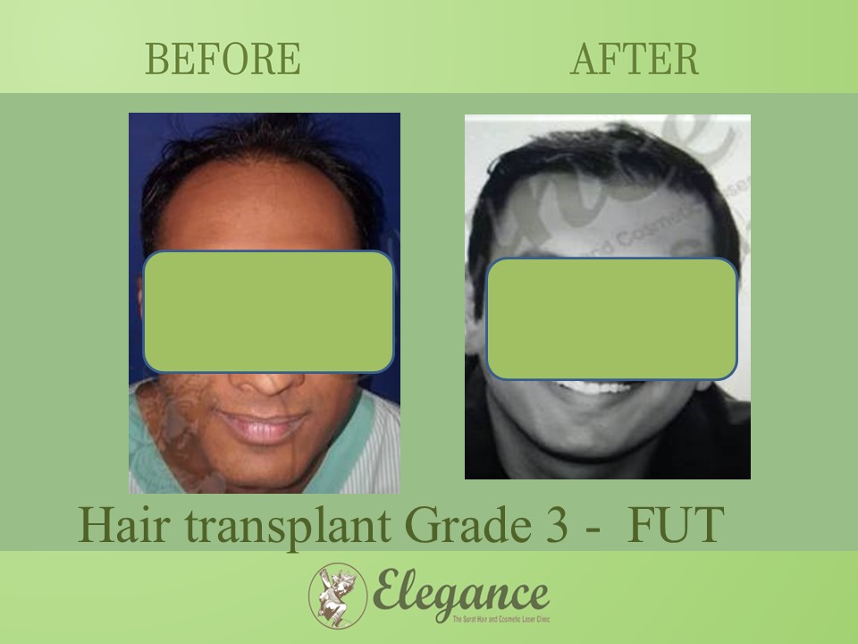 Hair transplant Grade 3 In Hazira, Gujarat, India