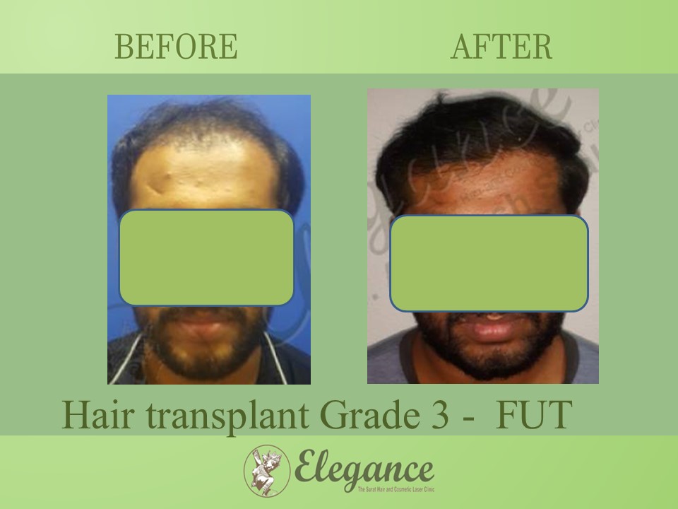 Hair transplant Grade 3 In Kamrej, Gujarat, India