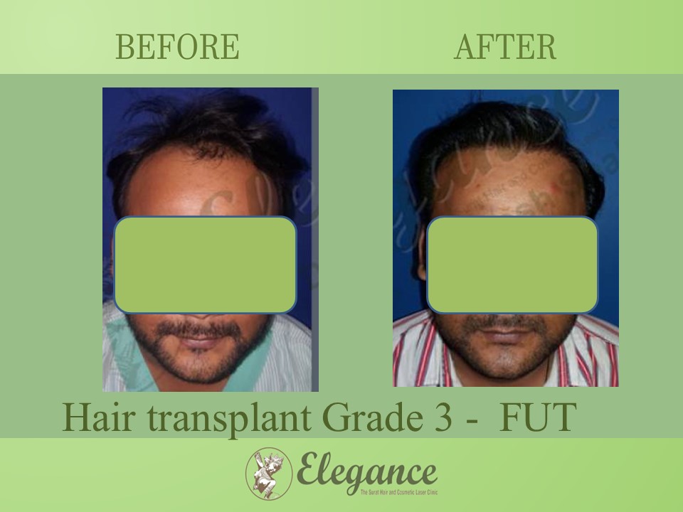 Hair transplant Grade 3 In Kim, Gujarat, India