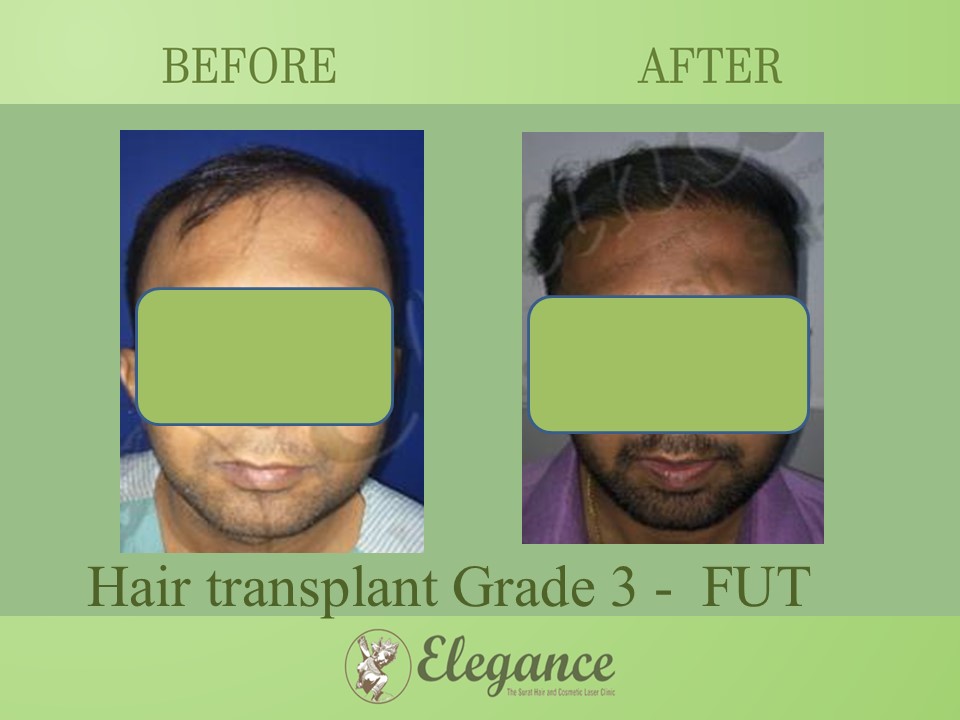 Hair transplant Grade 3 In Kosamba, Gujarat, India