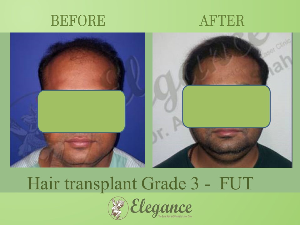 Hair transplant Grade 3 In Mangrol, Gujarat, India