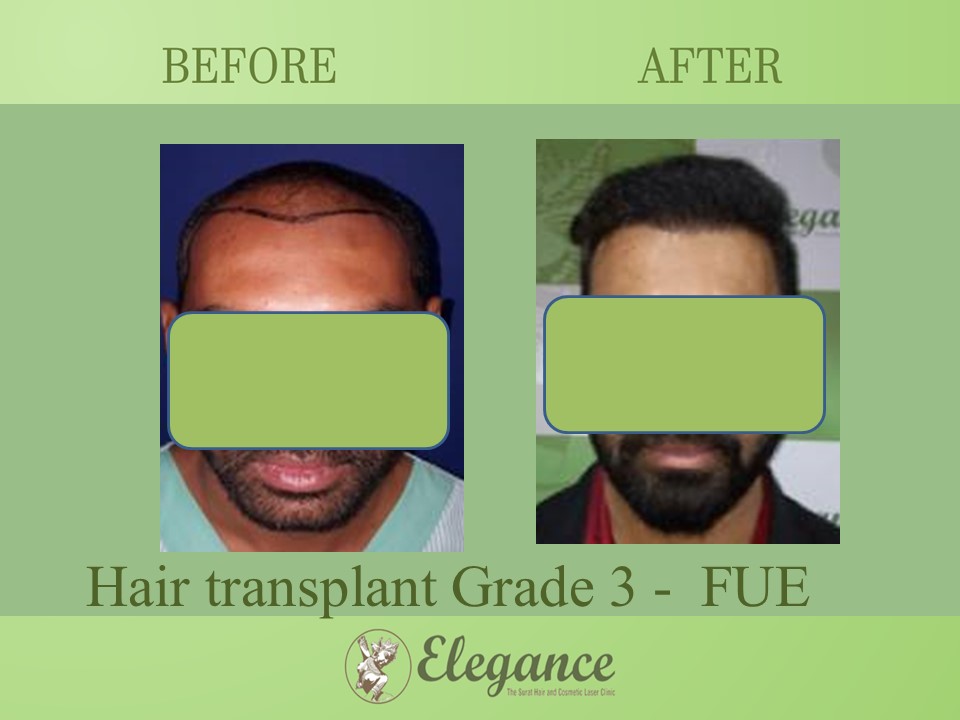 Hair transplant Grade 3 In Navsari, Gujarat, India