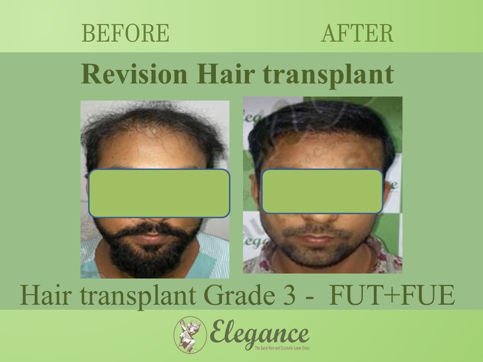 Hair transplant Grade 3 In Udhna, Gujarat, India