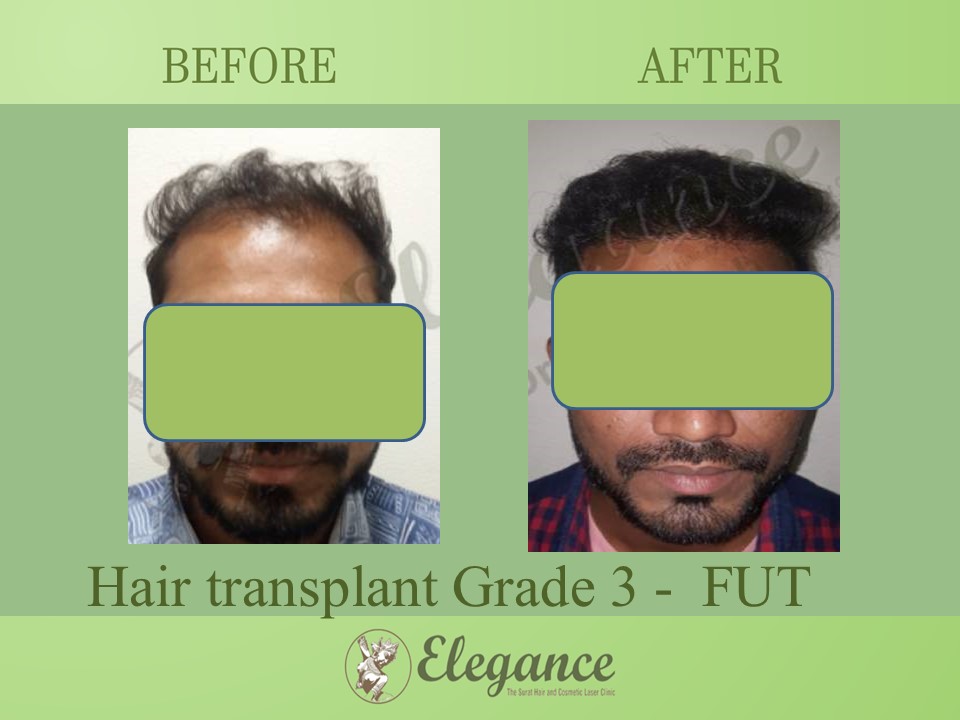 Hair transplant Grade 3 In Valsad, Gujarat, India