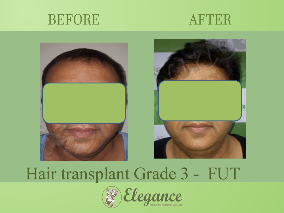 Hair transplant Grade 3 In Vapi, Gujarat, India