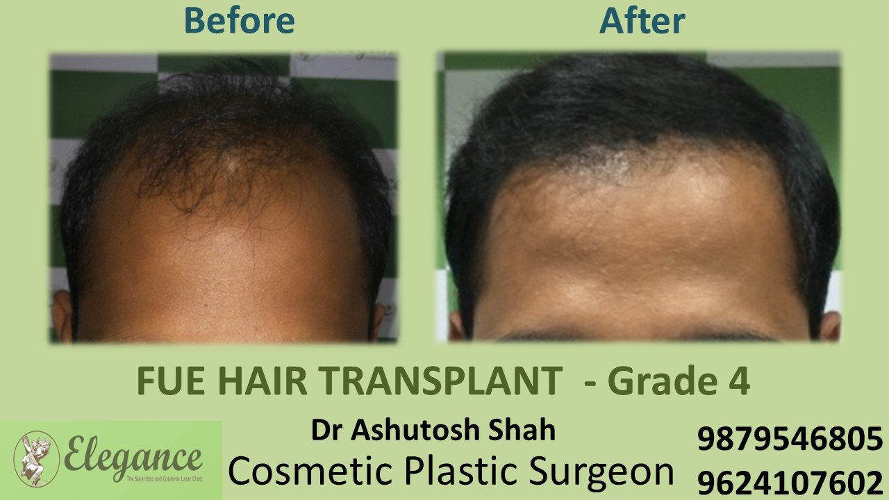 HAIR TRANSPLANT Grade 4 In Ahemdabad, Gujarat, India