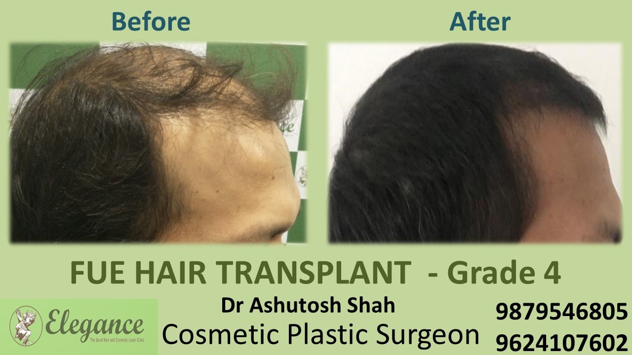 HAIR TRANSPLANT Grade 4 In Athwaget, Surat, Gujarat