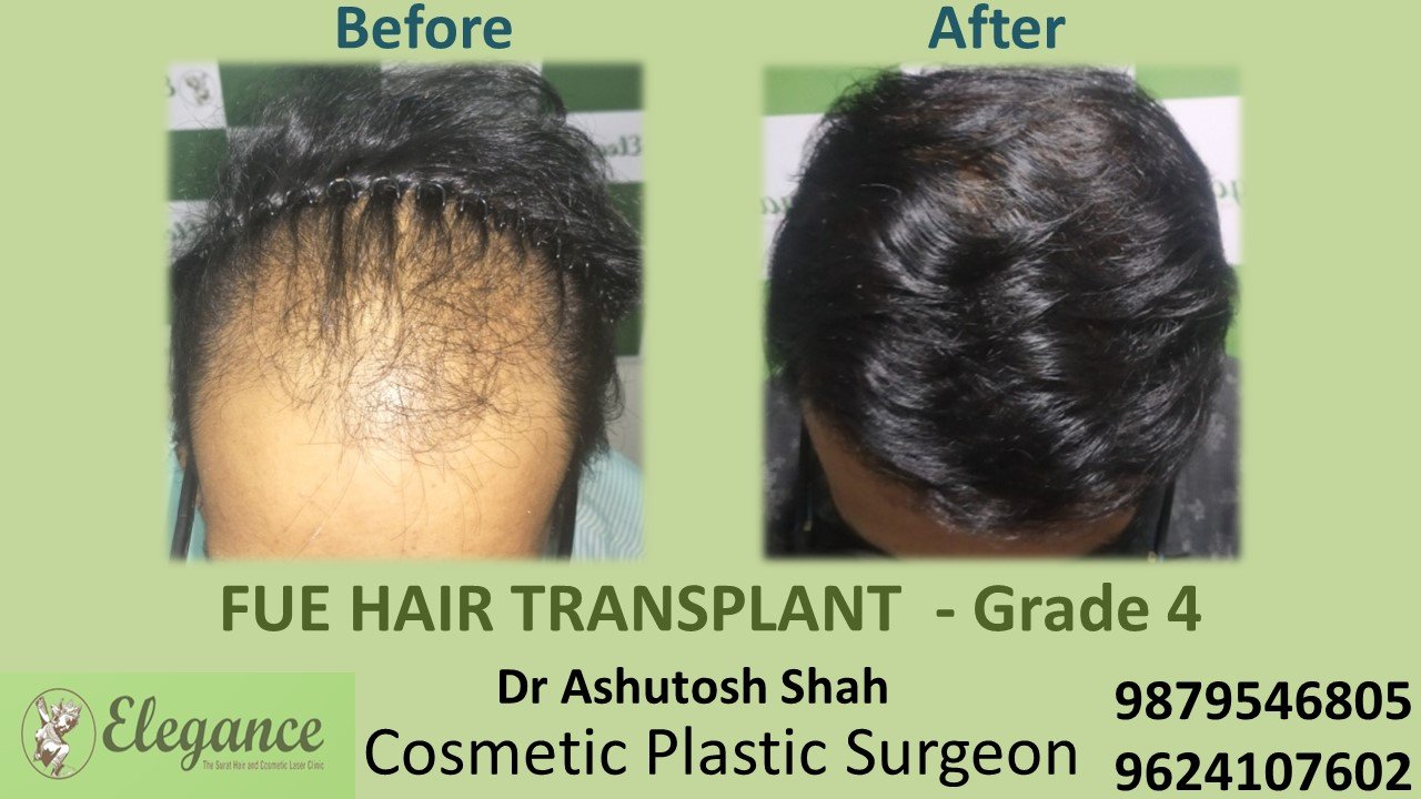 HAIR TRANSPLANT Grade 4 In Bhestan, Surat, Gujarat