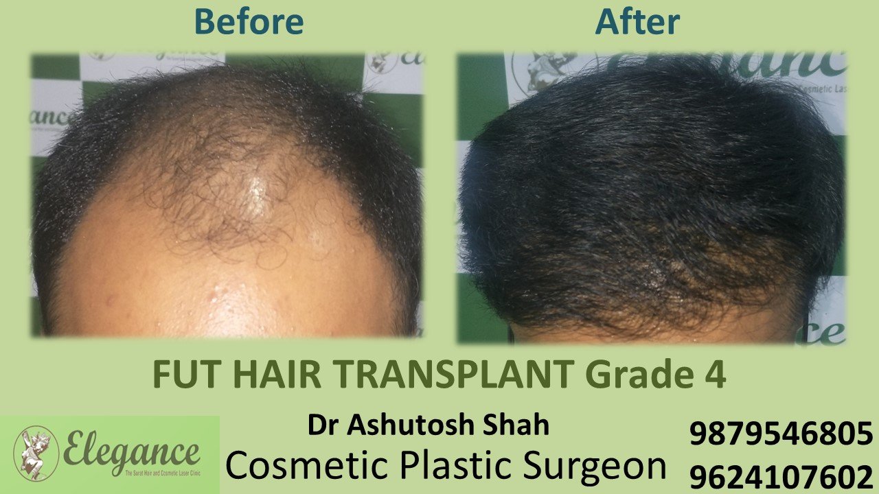 HAIR TRANSPLANT Grade 4 In Chikhli, Gujarat, India