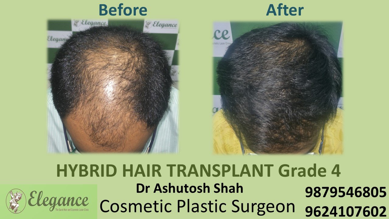 HAIR TRANSPLANT Grade 4 In Kim, Gujarat, India