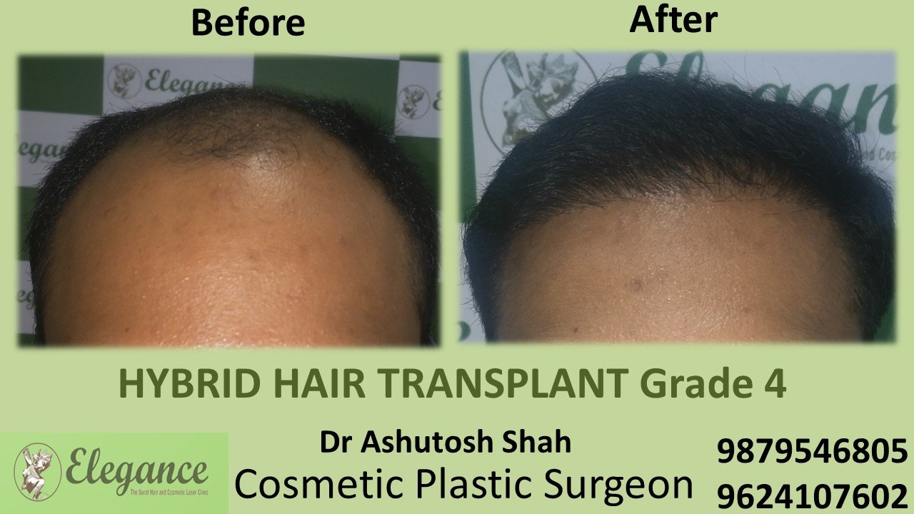 HAIR TRANSPLANT Grade 4 In Kosamba, Gujarat, India