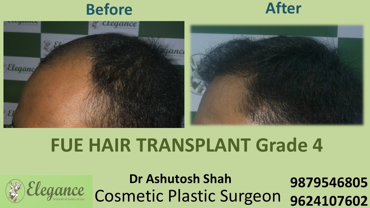 HAIR TRANSPLANT Grade 4 In Selvasa, Gujarat, India