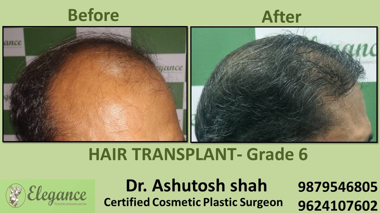 Hair Transplant GRADE 6, Daman, Gujarat, India.