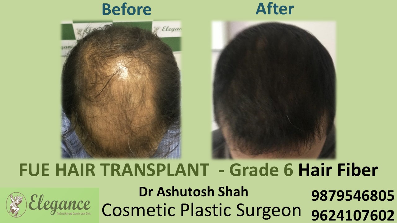 Hair Transplant GRADE 6, Surat, Gujarat, India.