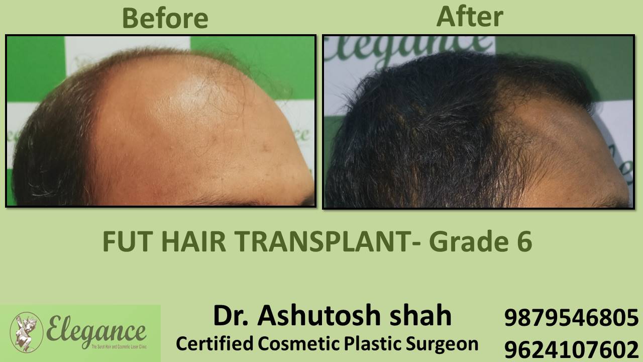 Hair Transplant GRADE 6, Valsad, Gujarat, India.