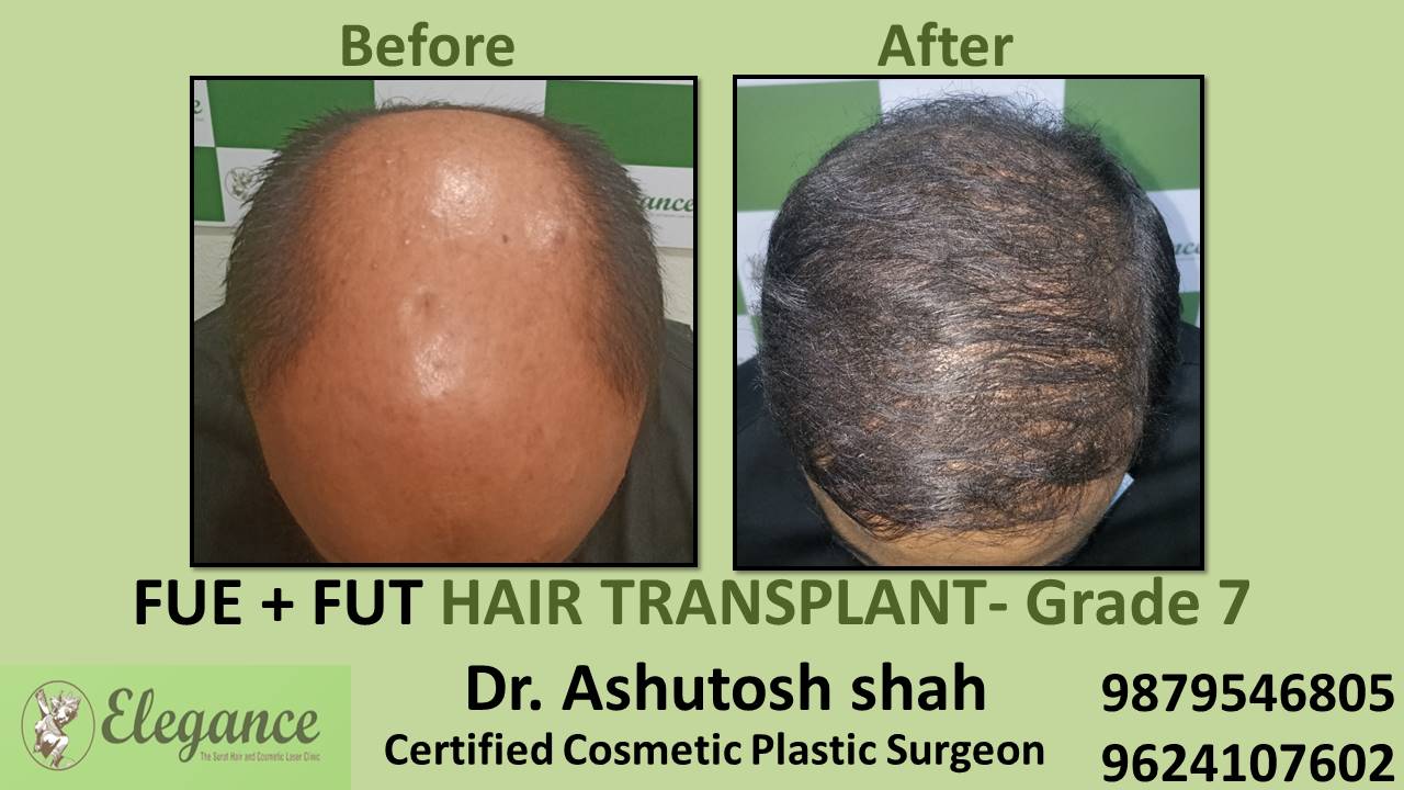 Hair Transplant GRADE 7, Ahemdabad, Gujarat, India.
