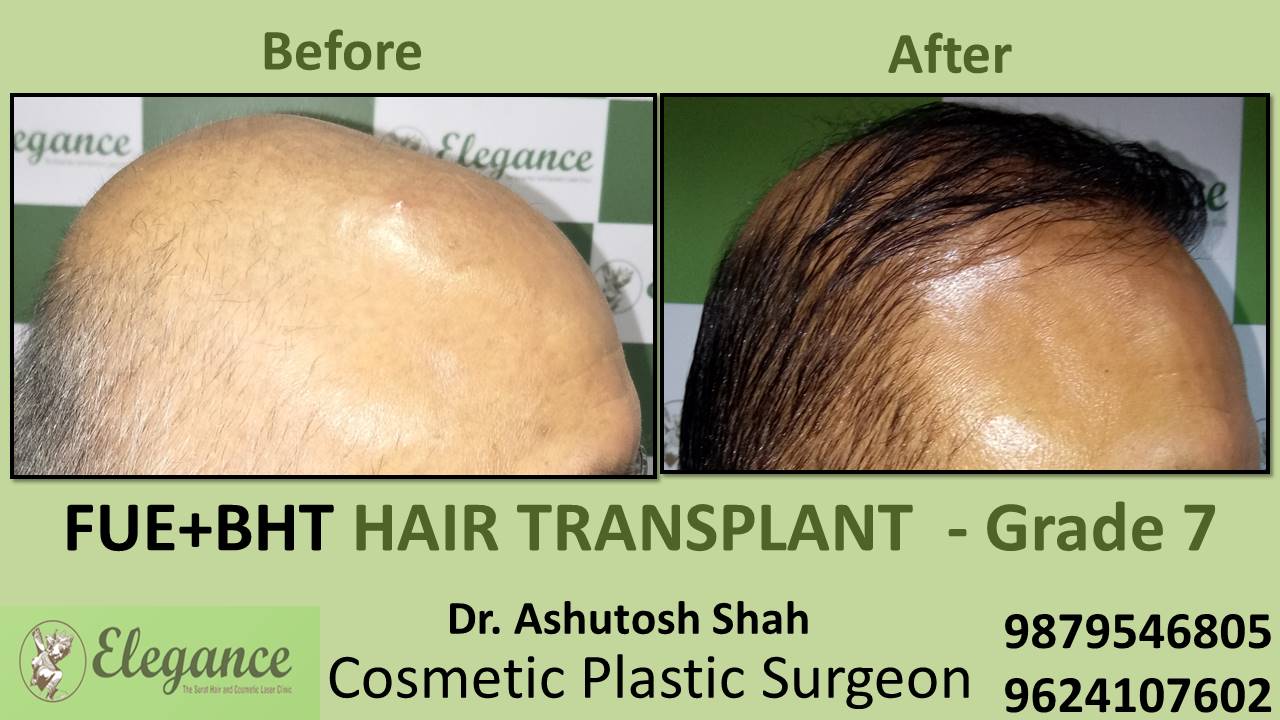 Hair Transplant GRADE 7, Bharuch, Gujarat, India.