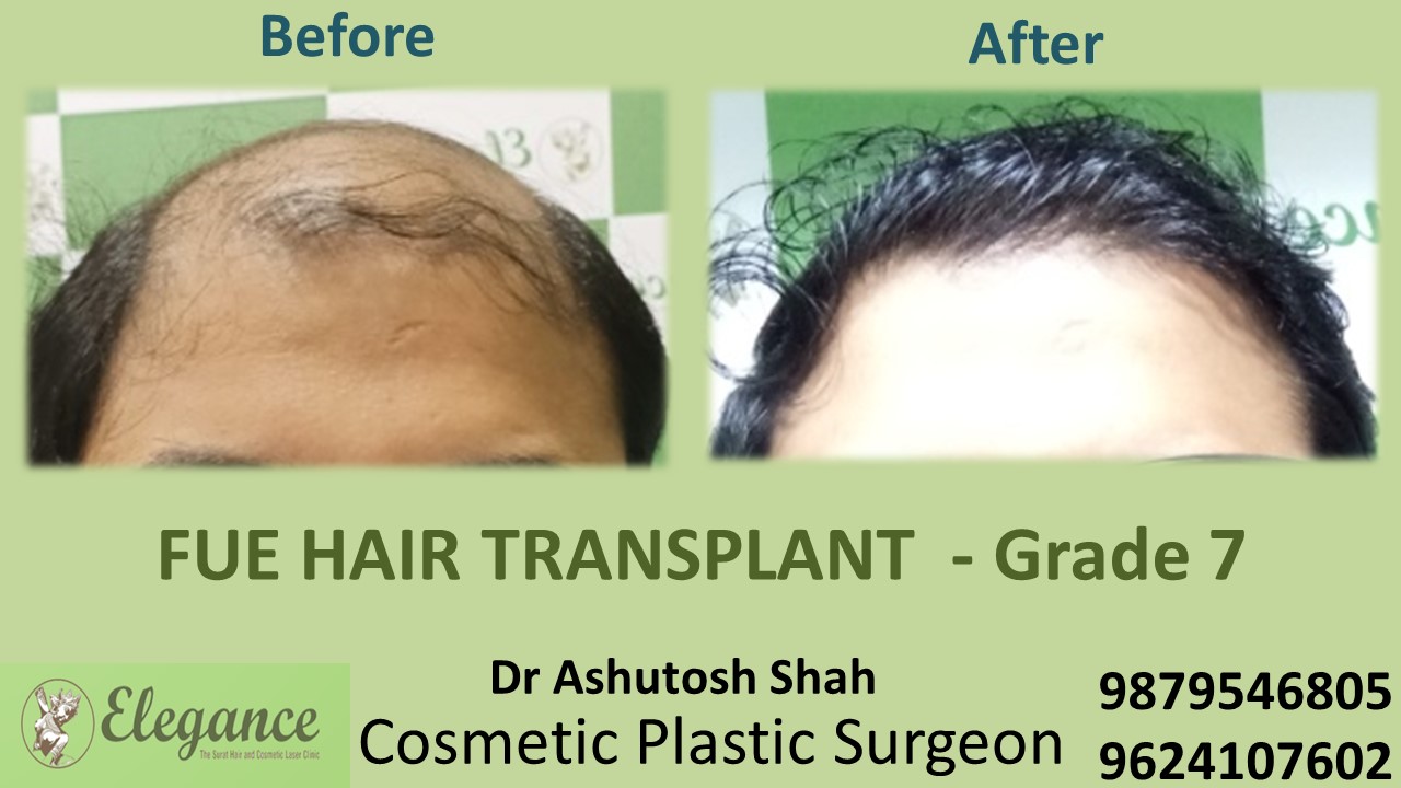 Hair Transplant GRADE 7, Navsari, Gujarat, India.