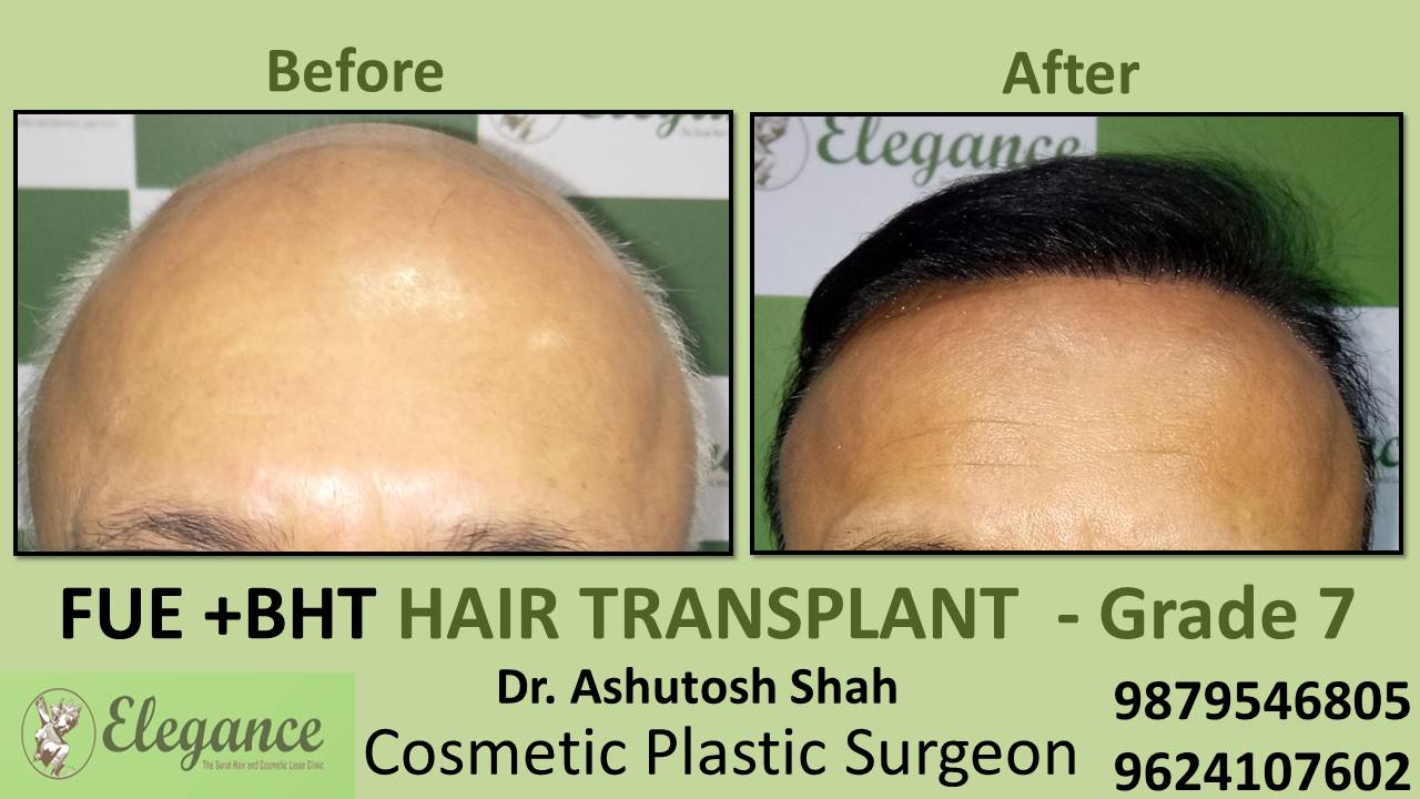 Hair Transplant GRADE 7, Surat, Gujarat, India.