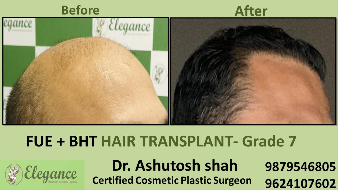 Hair Transplant GRADE 7, Vapi, Gujarat, India.