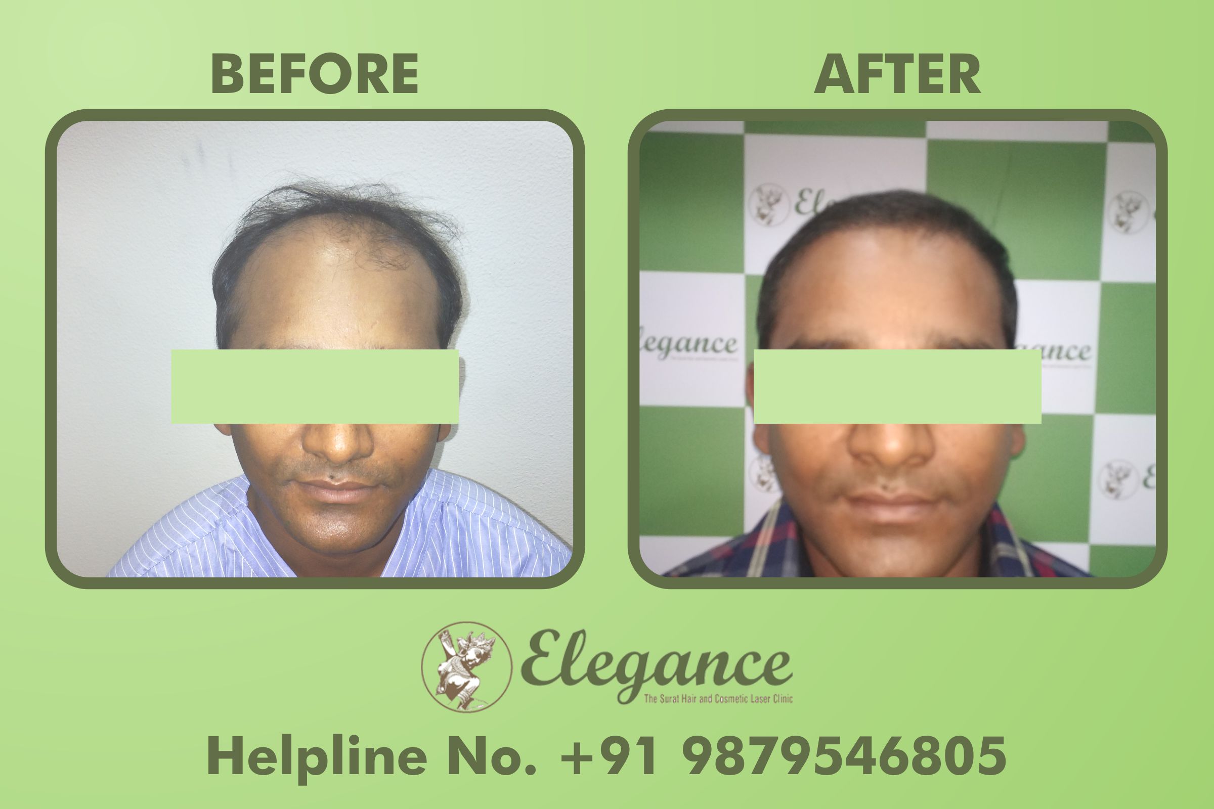 Hair Transplant in Bharuch Price