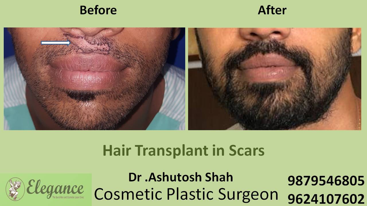 Hair Transplant in Scar Treatment, Surat, Gujarat