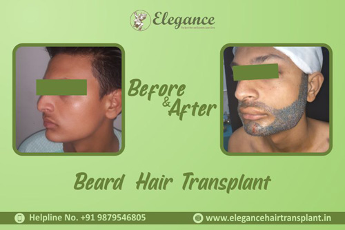 Beard Hair Transplant Clinic in Surat, Gujarat, india