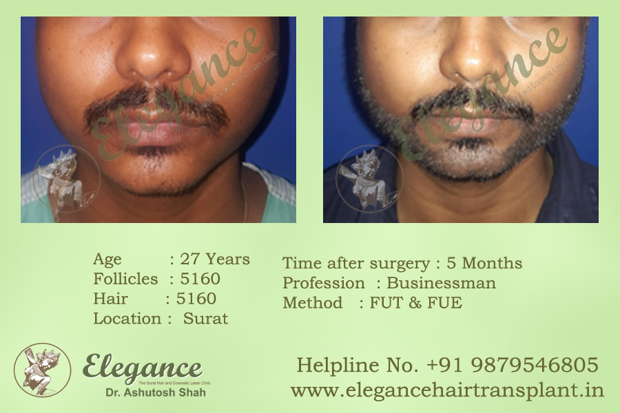 Beard Hair Transplant cost in Surat, Gujarat, india