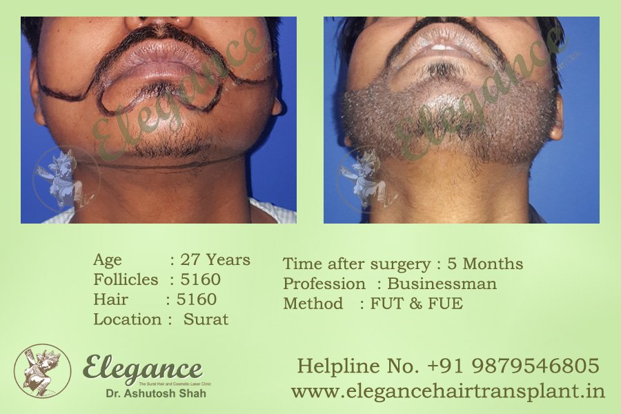 Beard Hair Transplant in Surat