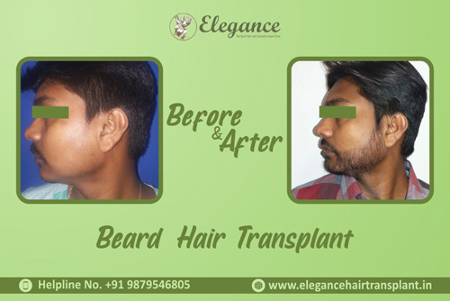 Best Beard Hair Transplant Doctor in Surat, Gujarat, india