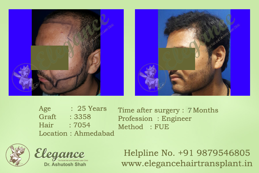Beard Transplant Result In Vapi, Gujarat, India