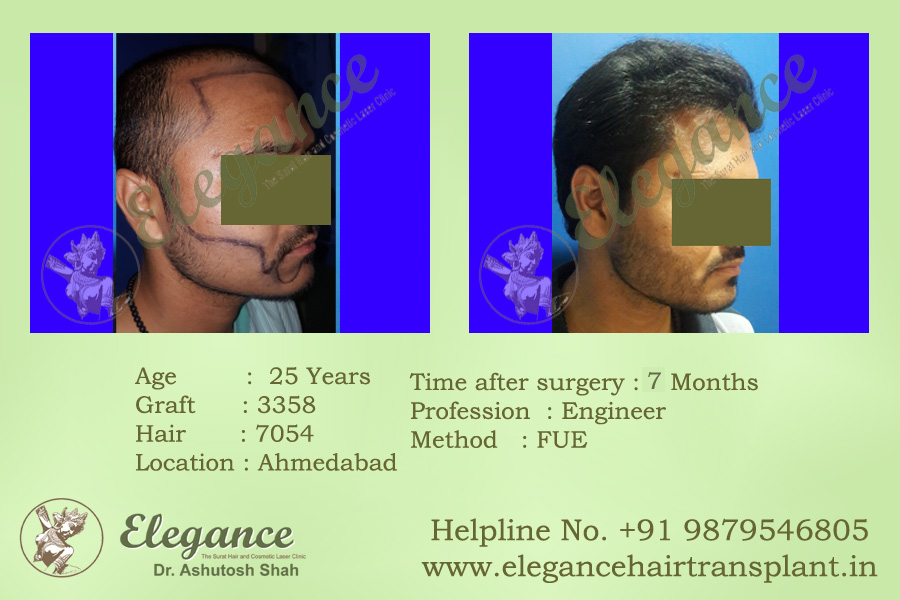 Beard Transplant Result In Ahmedabad, Gujarat, India
