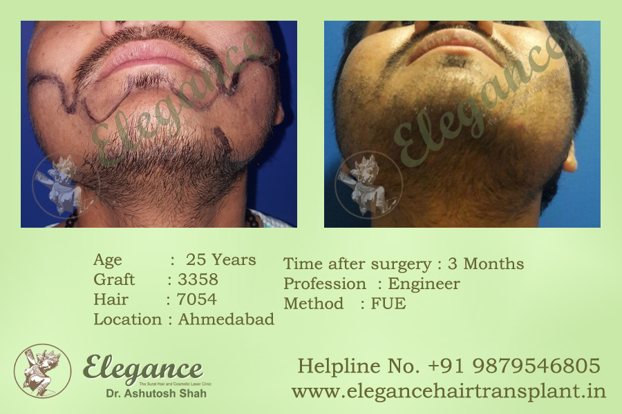 Beard Transplant Cost In Ahmedabad, Gujarat, India