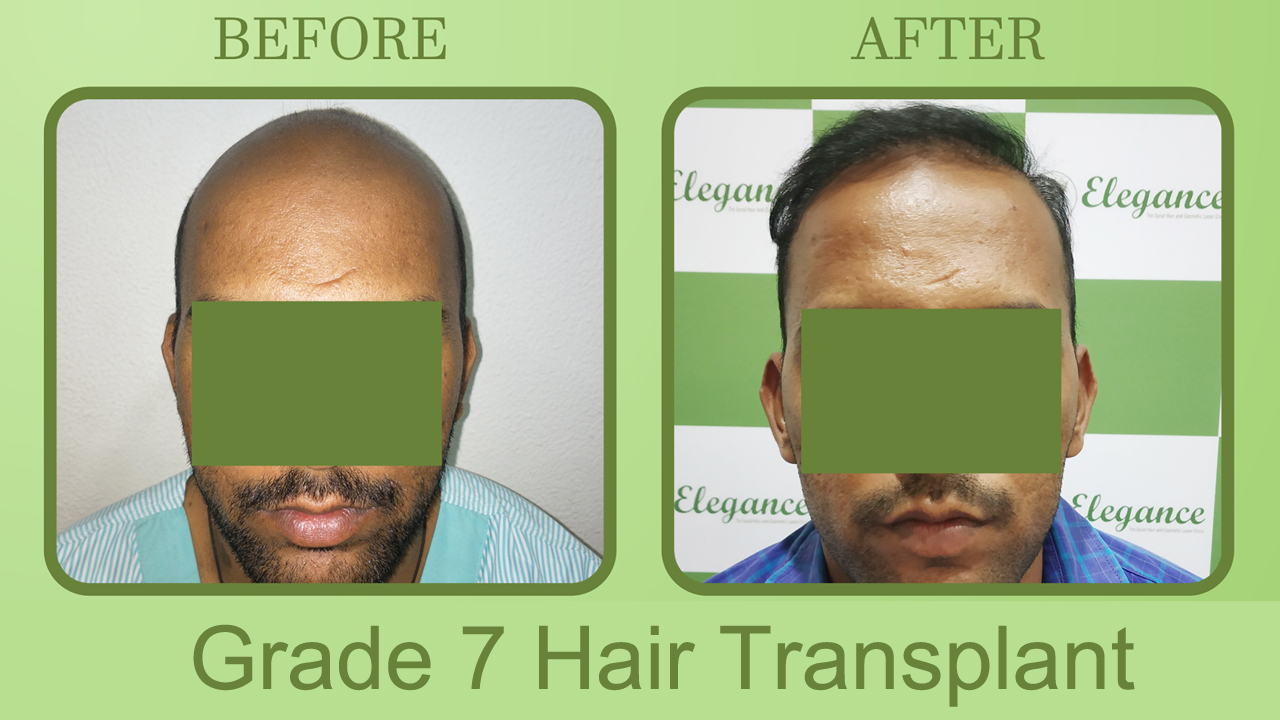Best Hair Transplant Surgeon in Ahmedabad, Gujarat, India