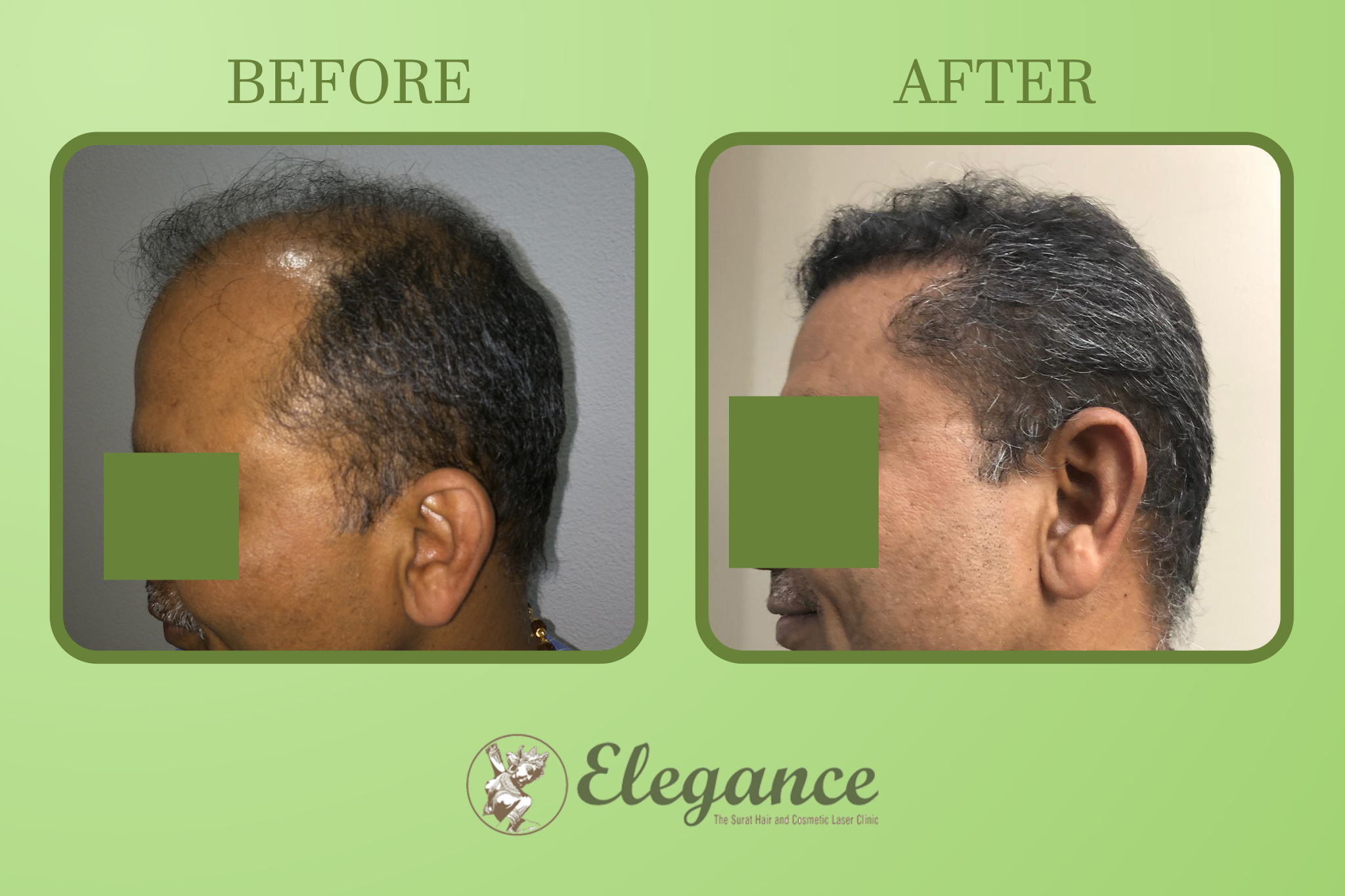 Best Hair Transplant Surgeon in Anand, Gujarat, India