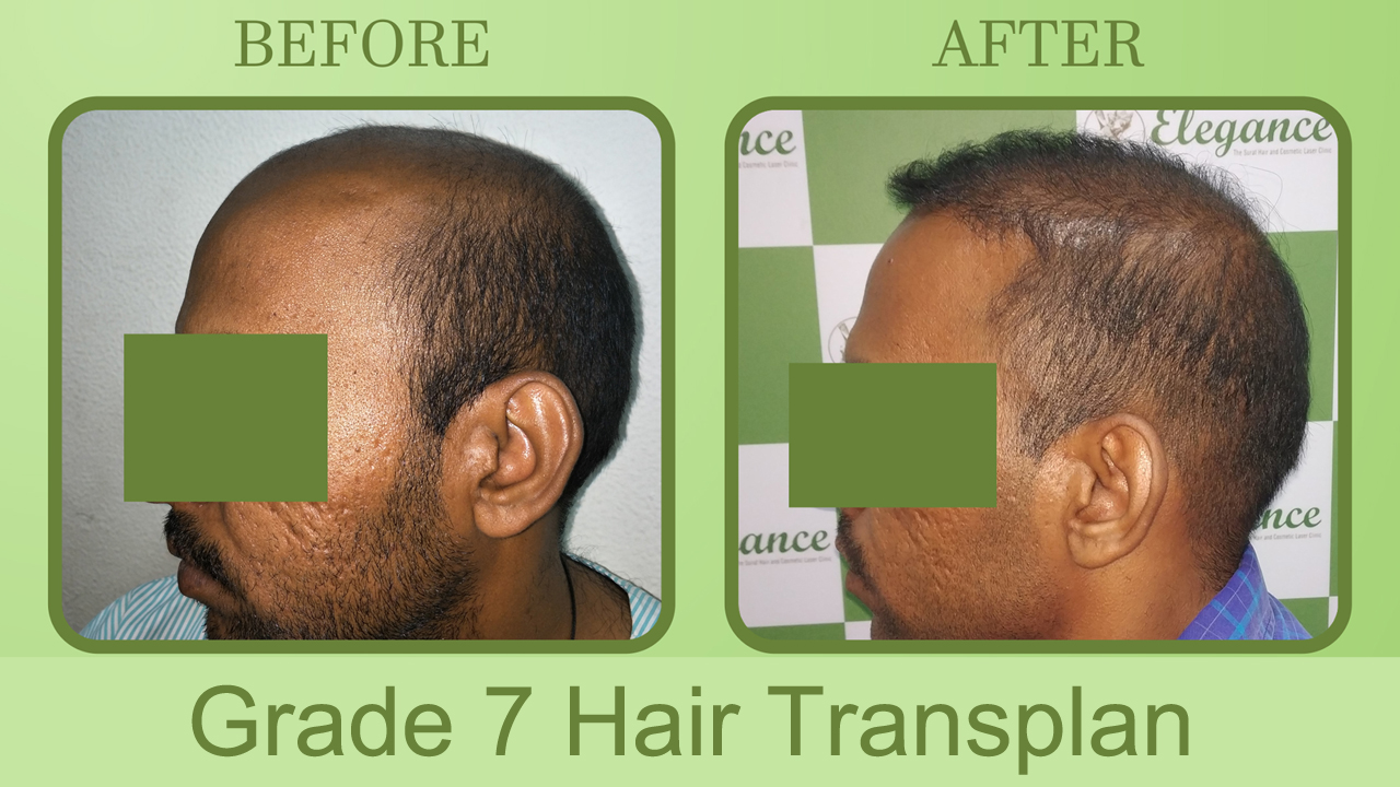 Best Hair Transplant Surgeon in Patan, Gujarat, India