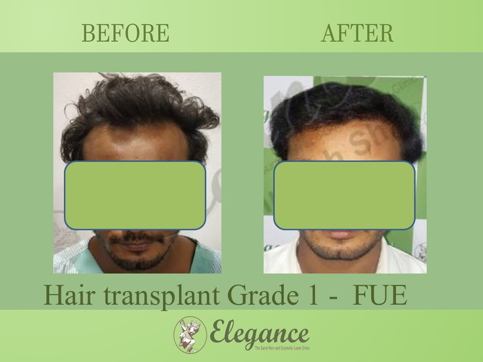 Cost Hair Transplant In Chittaurgarh, Rajasthan, India