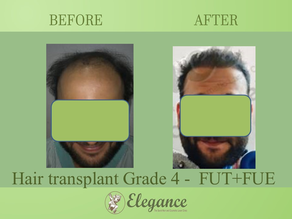 Cost Hair Transplant In Jaipur, Rajasthan, India