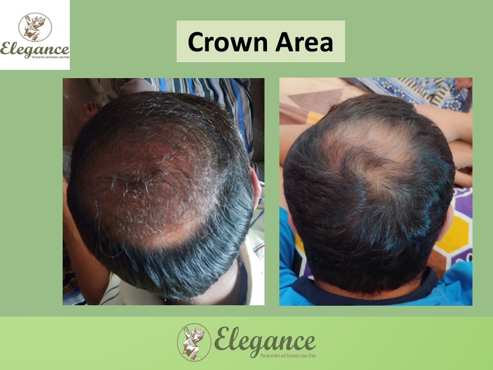 Cost Hair Transplant In Jalore, Rajasthan, India